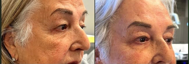 BioBlend Method® Under-Eye Rejuvenation