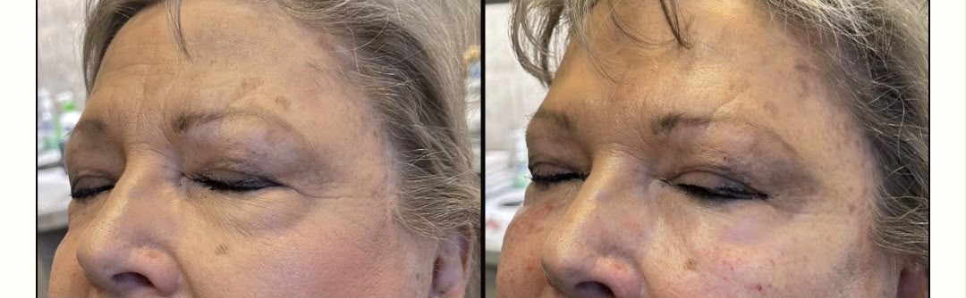 BioBlend Method® Under-Eye Rejuvenation
