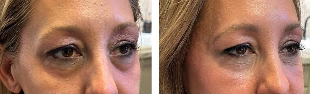 BioBlend Method® Under-Eye Rejuvenation