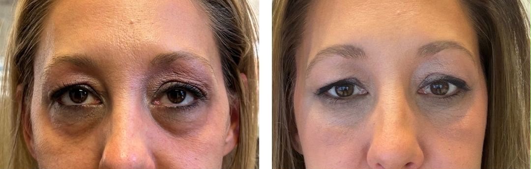BioBlend Method® Under-Eye Rejuvenation