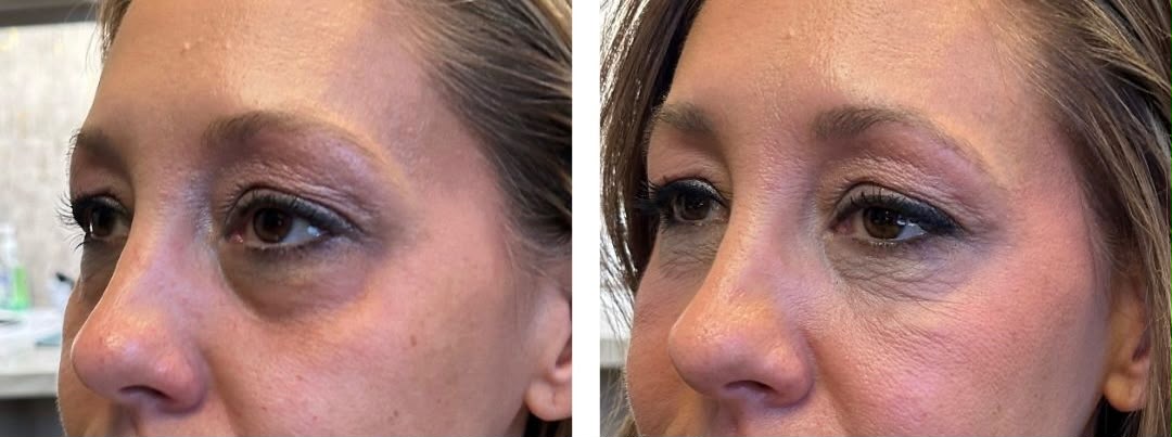 BioBlend Method® Under-Eye Rejuvenation