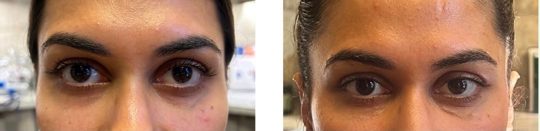 BioBlend Method® Under-Eye Rejuvenation