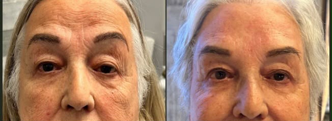 BioBlend Method® Under-Eye Rejuvenation