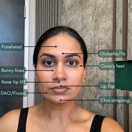 botox treatment injection areas